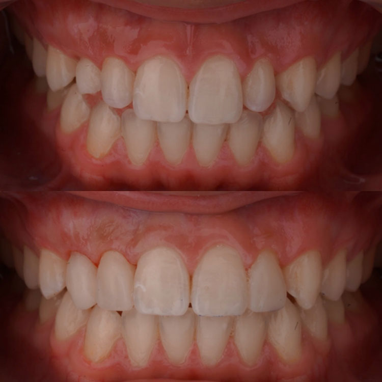 Composite filling